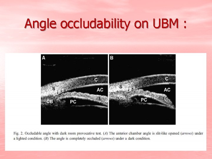 Angle occludability on UBM : 