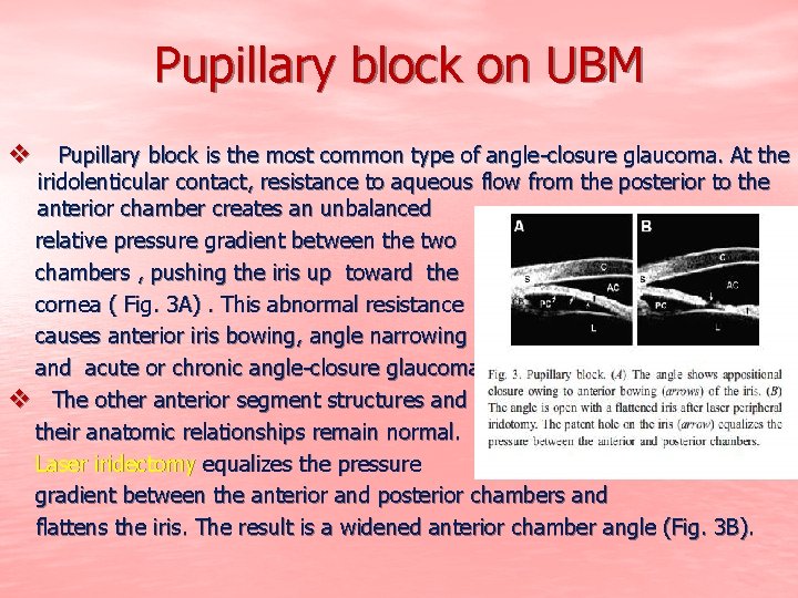 Pupillary block on UBM v Pupillary block is the most common type of angle-closure