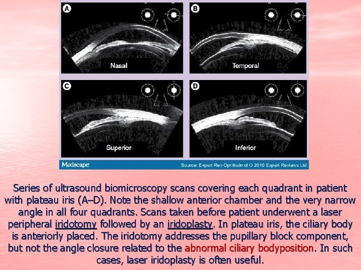 Series of ultrasound biomicroscopy scans covering each quadrant in patient with plateau iris (A–D).