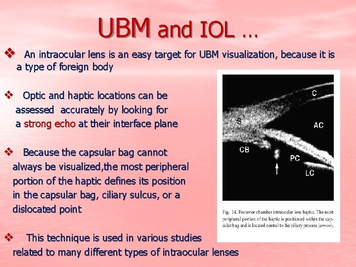 UBM and IOL … v An intraocular lens is an easy target for UBM