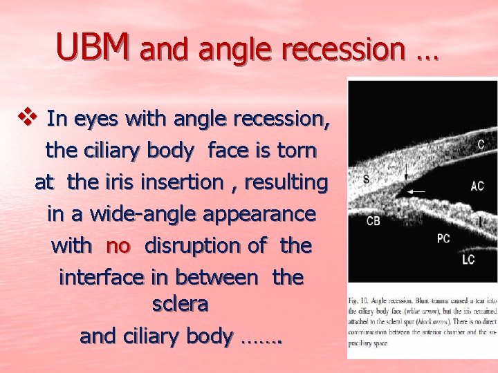 UBM and angle recession … v In eyes with angle recession, the ciliary body