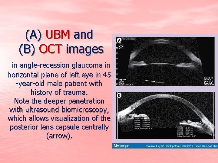 (A) UBM and (B) OCT images in angle-recession glaucoma in horizontal plane of left