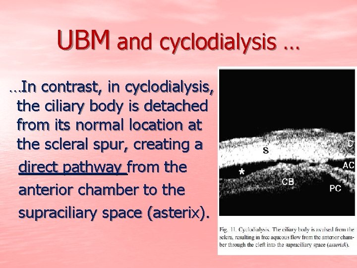 UBM and cyclodialysis … …In contrast, in cyclodialysis, the ciliary body is detached from