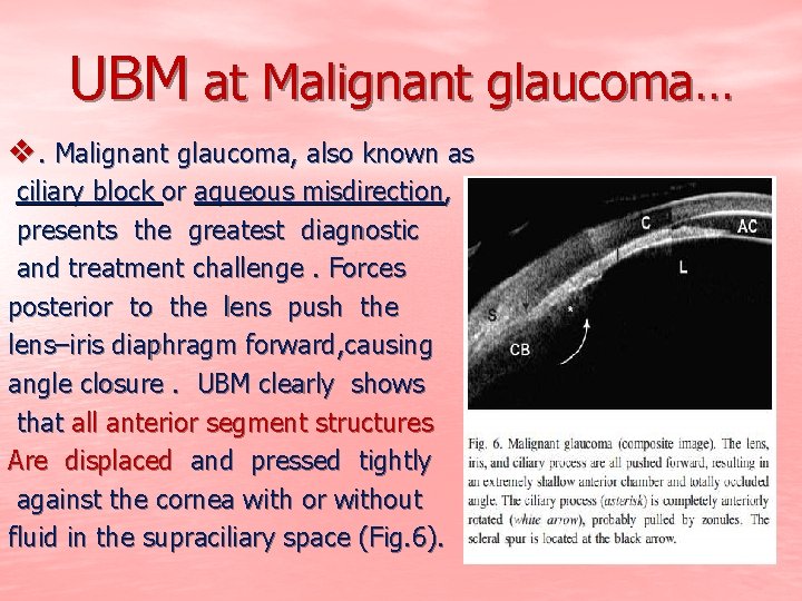 UBM at Malignant glaucoma… v. Malignant glaucoma, also known as ciliary block or aqueous