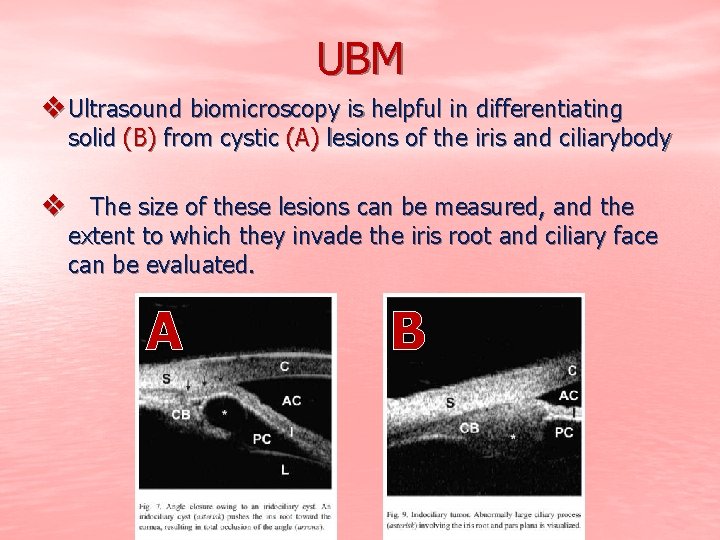 UBM v Ultrasound biomicroscopy is helpful in differentiating solid (B) from cystic (A) lesions