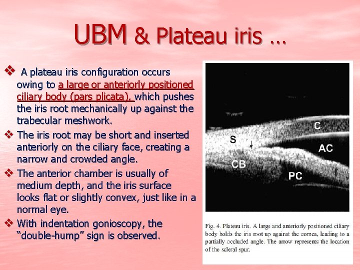 UBM & Plateau iris … v A plateau iris configuration occurs owing to a