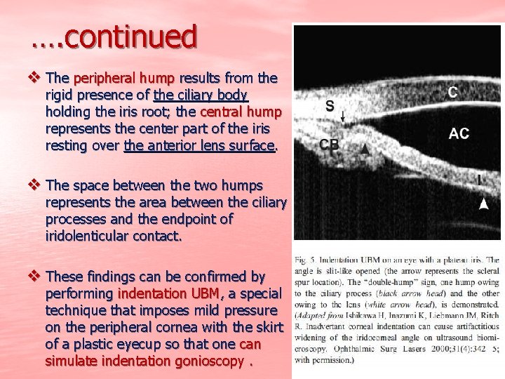 …. continued v The peripheral hump results from the rigid presence of the ciliary