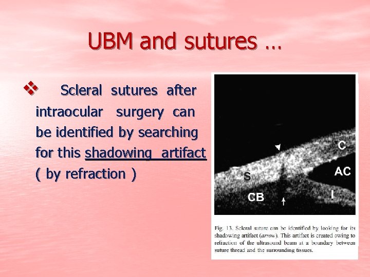 UBM and sutures … v Scleral sutures after intraocular surgery can be identified by