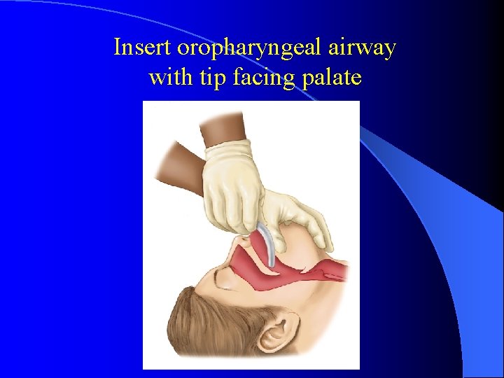 Insert oropharyngeal airway with tip facing palate 
