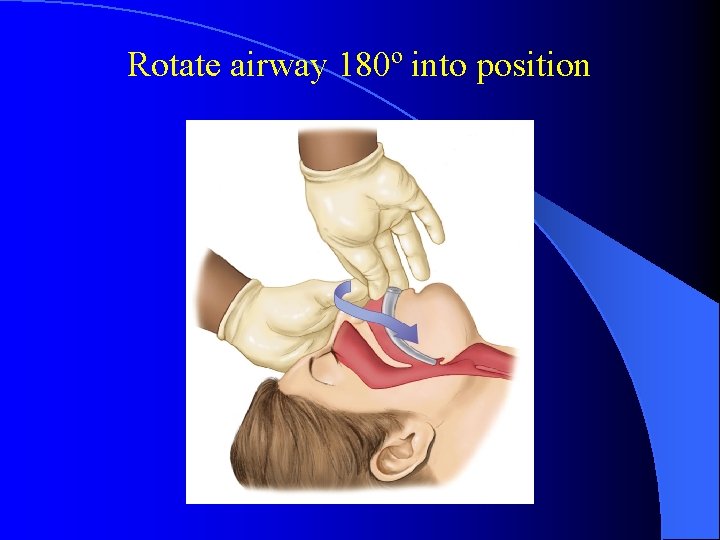 Rotate airway 180º into position 
