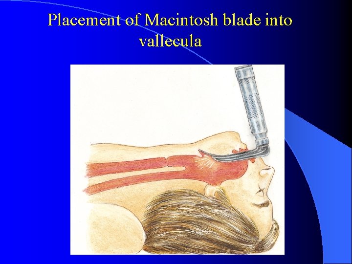 Placement of Macintosh blade into vallecula 