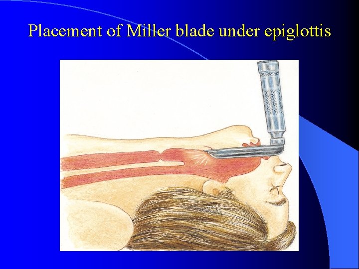 Placement of Miller blade under epiglottis 