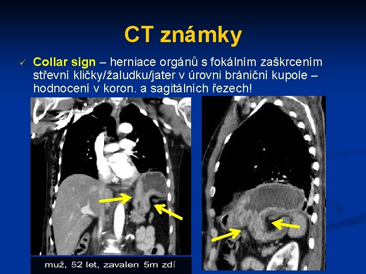 CT známky ü Collar sign – herniace orgánů s fokálním zaškrcením střevní kličky/žaludku/jater v