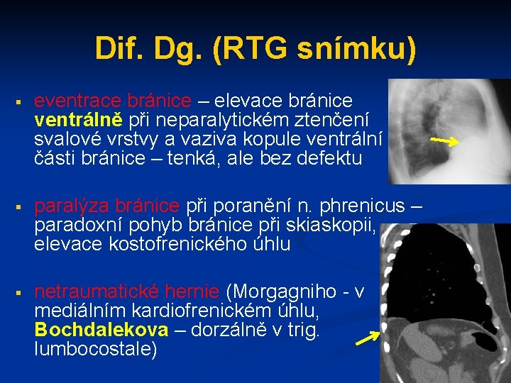 Dif. Dg. (RTG snímku) § eventrace bránice – elevace bránice ventrálně při neparalytickém ztenčení