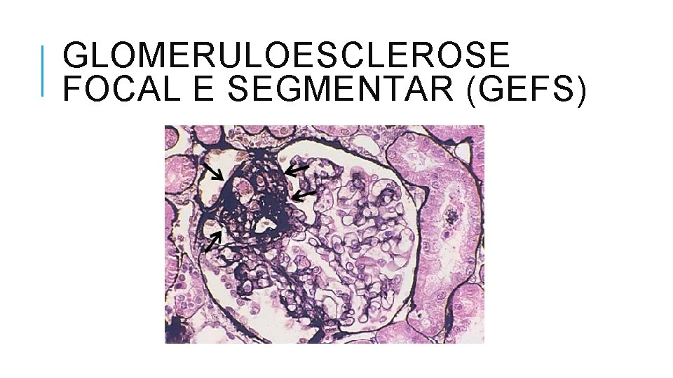 GLOMERULOESCLEROSE FOCAL E SEGMENTAR (GEFS) 