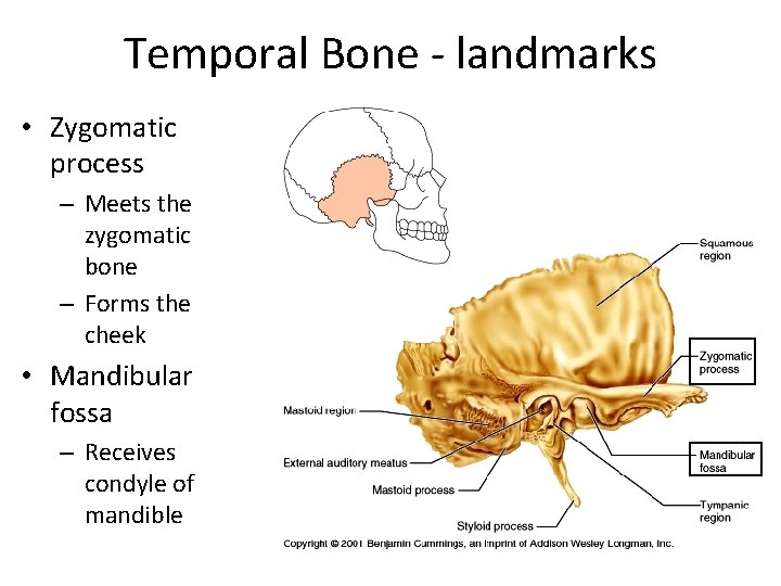 Temporal Bone - landmarks • Zygomatic process – Meets the zygomatic bone – Forms
