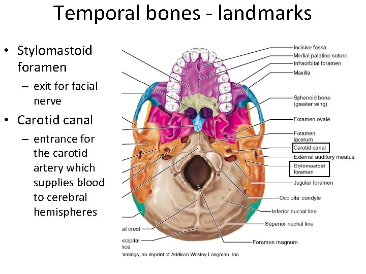 Temporal bones - landmarks • Stylomastoid foramen – exit for facial nerve • Carotid