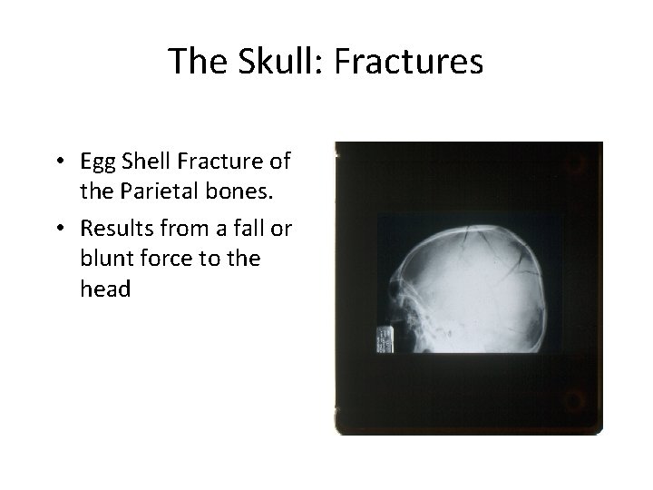 The Skull: Fractures • Egg Shell Fracture of the Parietal bones. • Results from