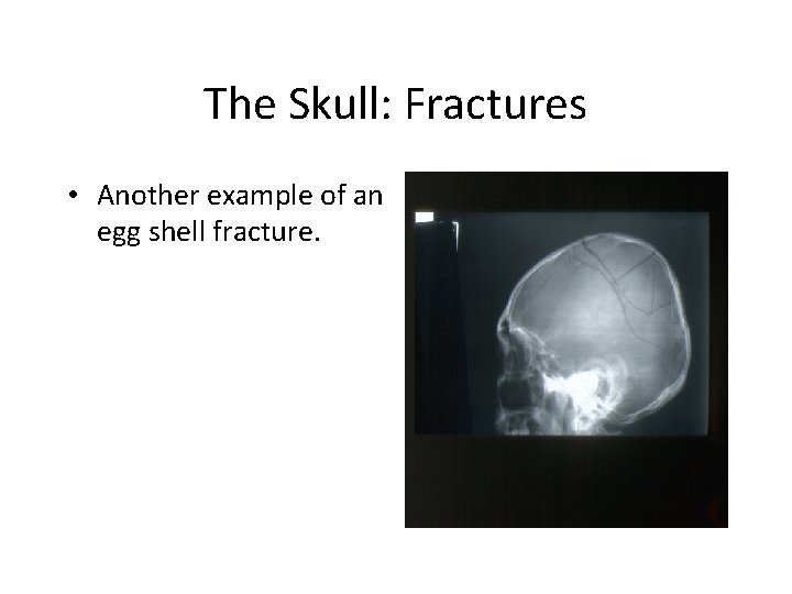 The Skull: Fractures • Another example of an egg shell fracture. 