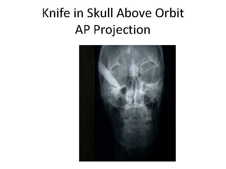 Knife in Skull Above Orbit AP Projection 