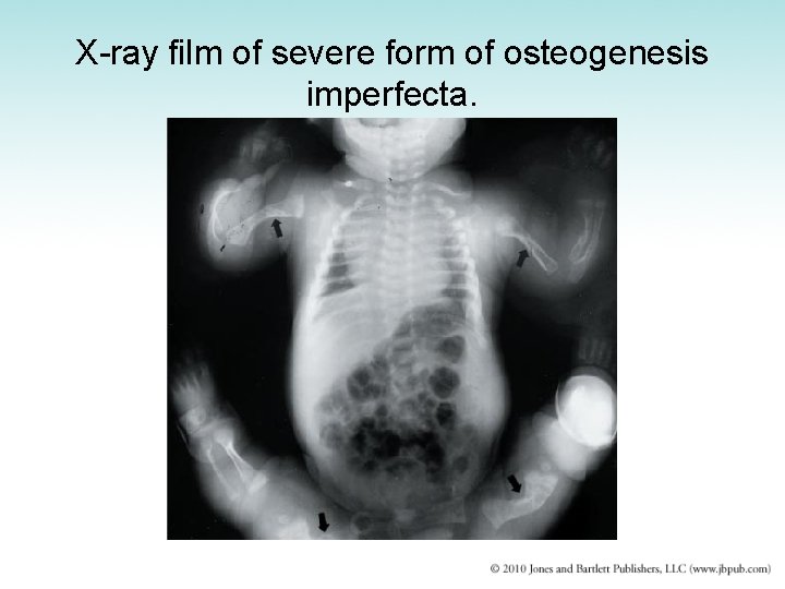 X-ray film of severe form of osteogenesis imperfecta. 