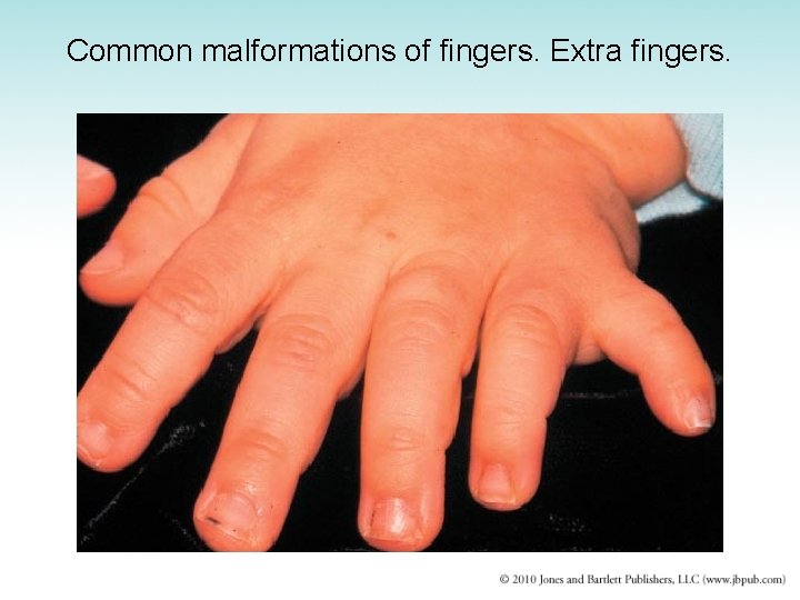 Common malformations of fingers. Extra fingers. 