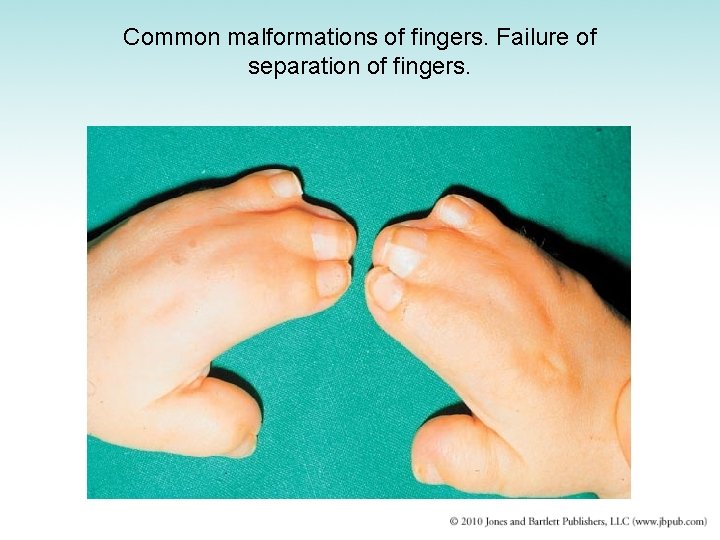 Common malformations of fingers. Failure of separation of fingers. 