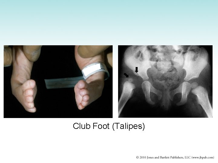 Club Foot (Talipes) 