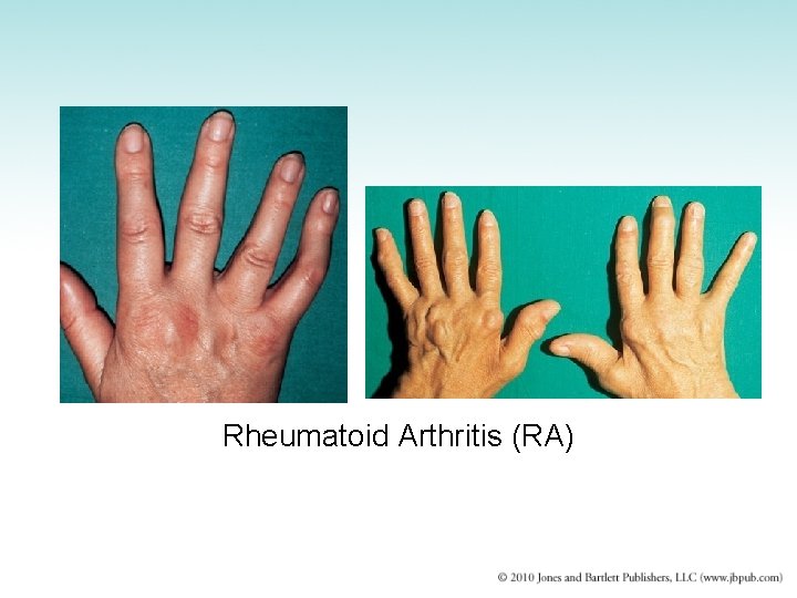 Rheumatoid Arthritis (RA) 