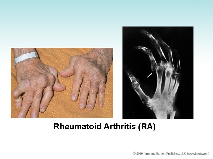 Rheumatoid Arthritis (RA) 