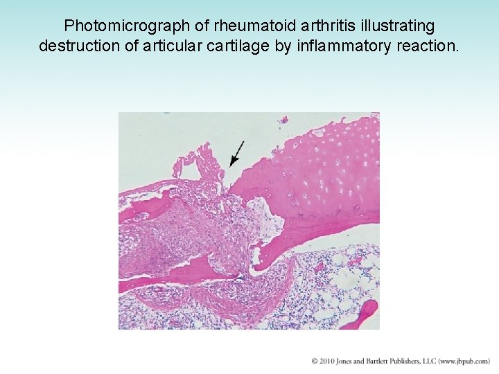 Photomicrograph of rheumatoid arthritis illustrating destruction of articular cartilage by inflammatory reaction. 