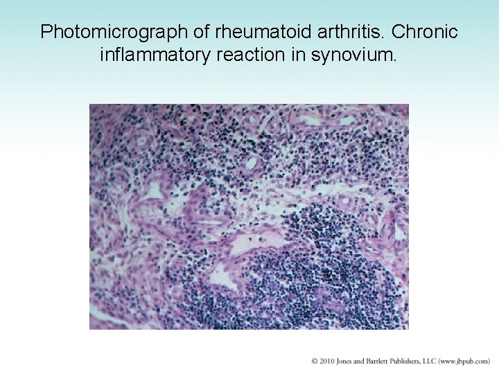 Photomicrograph of rheumatoid arthritis. Chronic inflammatory reaction in synovium. 