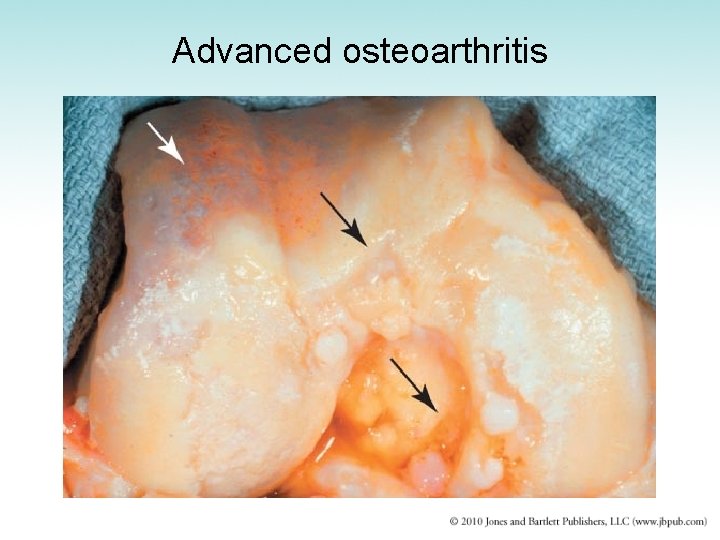 Advanced osteoarthritis 