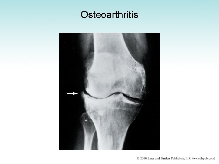 Osteoarthritis 