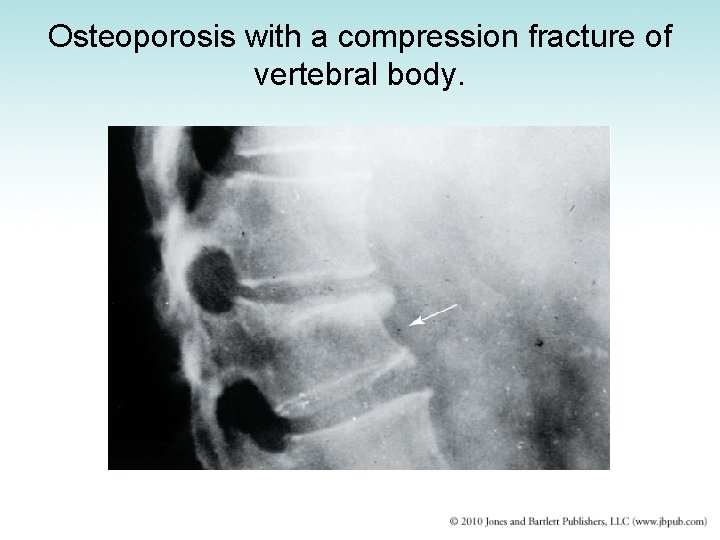 Osteoporosis with a compression fracture of vertebral body. 