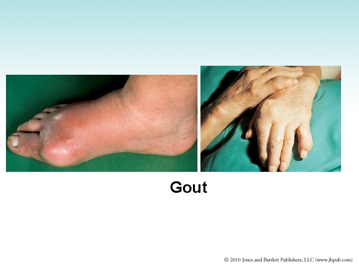 Gout 