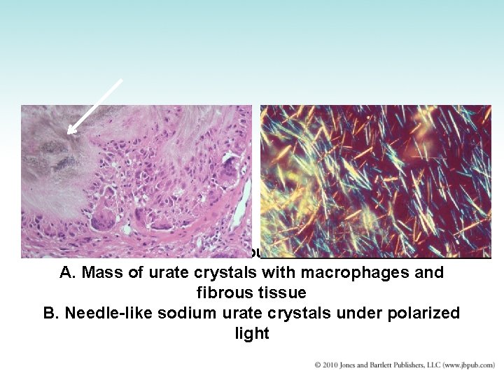 Gout A. Mass of urate crystals with macrophages and fibrous tissue B. Needle-like sodium