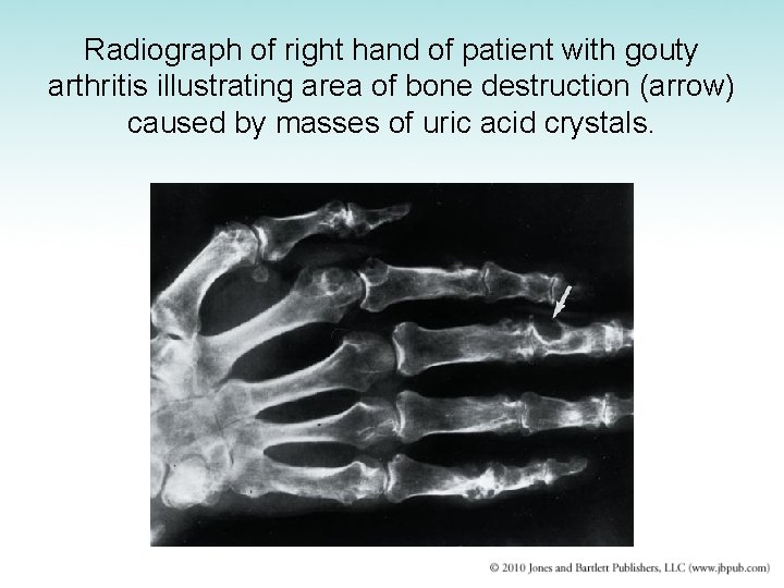 Radiograph of right hand of patient with gouty arthritis illustrating area of bone destruction