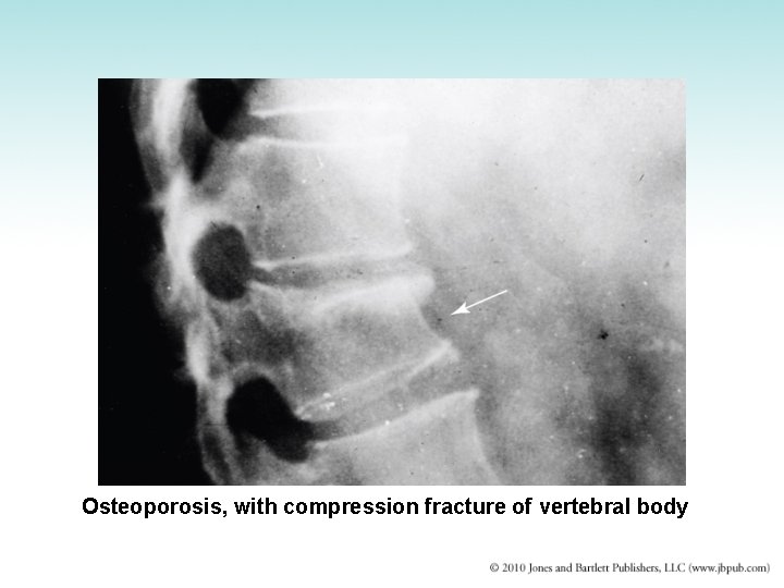 Osteoporosis, with compression fracture of vertebral body 