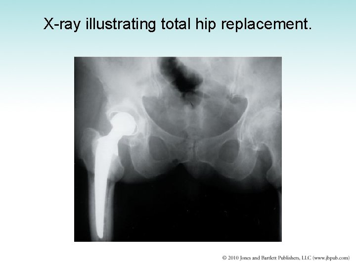 X-ray illustrating total hip replacement. 