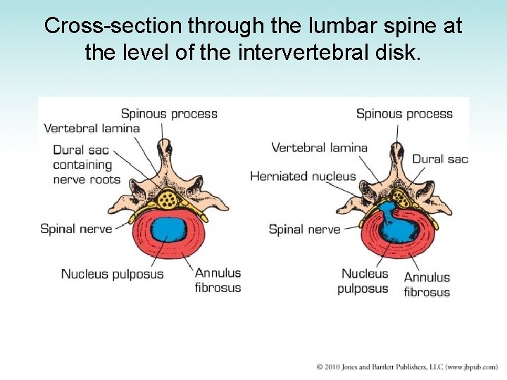 Cross-section through the lumbar spine at the level of the intervertebral disk. 