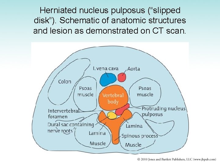 Herniated nucleus pulposus (“slipped disk”). Schematic of anatomic structures and lesion as demonstrated on