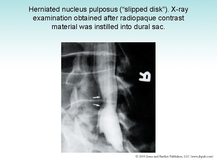 Herniated nucleus pulposus (“slipped disk”). X-ray examination obtained after radiopaque contrast material was instilled