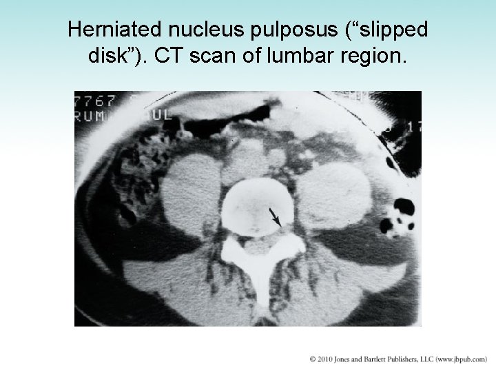 Herniated nucleus pulposus (“slipped disk”). CT scan of lumbar region. 