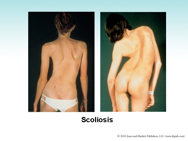 Scoliosis 