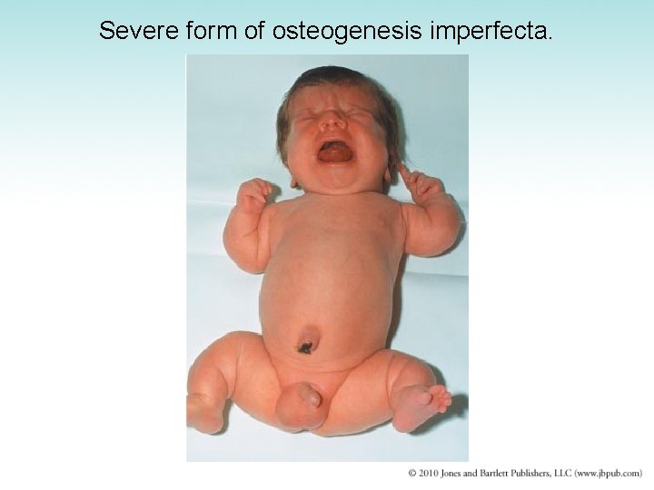 Severe form of osteogenesis imperfecta. 