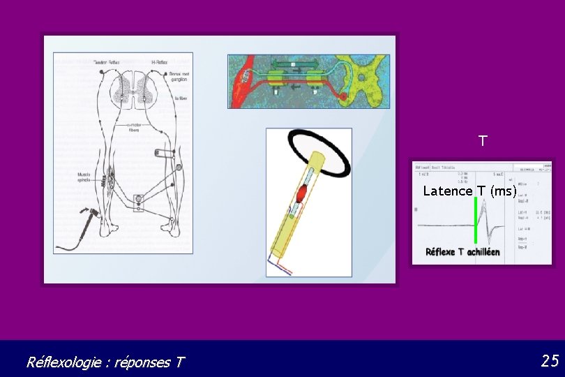T Latence T (ms) Réflexologie : réponses T 25 