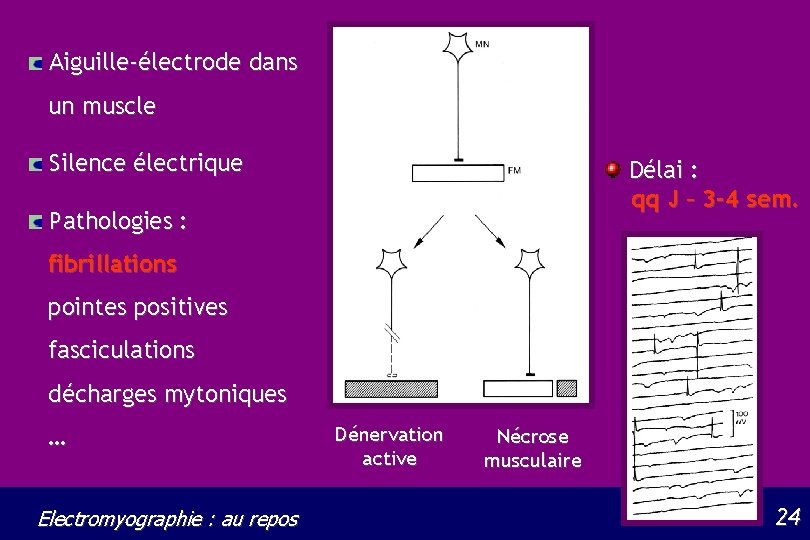 Aiguille-électrode dans un muscle Silence électrique Délai : qq J – 3 -4 sem.