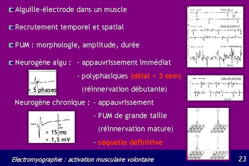 Aiguille-électrode dans un muscle Recrutement temporel et spatial PUM : morphologie, amplitude, durée Neurogène