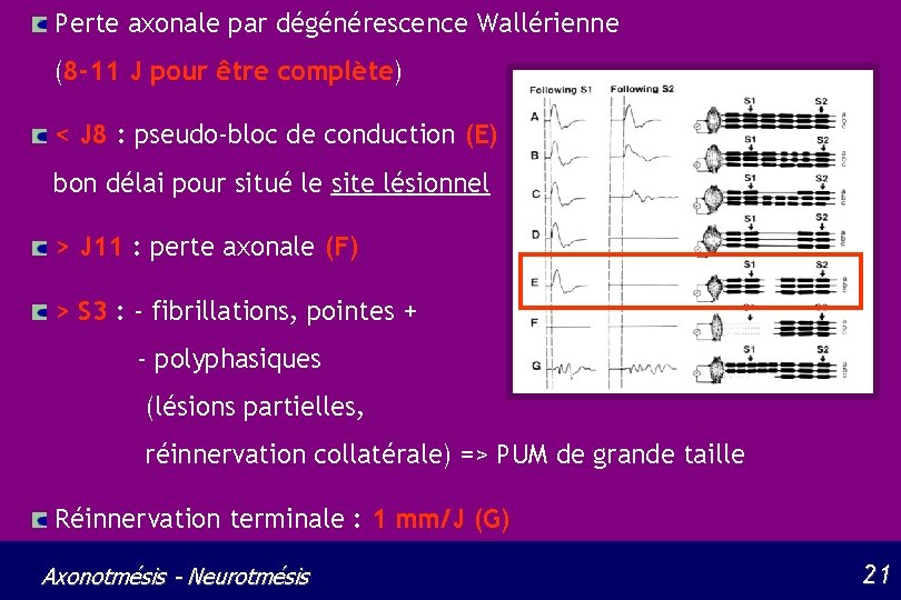 Perte axonale par dégénérescence Wallérienne (8 -11 J pour être complète) < J 8